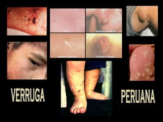 VERRUGA PERUANA 