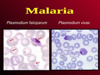 Plasmodium falciparum Plasmodium vivax Malaria 