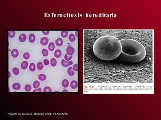 Esferocitosis hereditaria Tomado de Torres G. Medicine 2004; 9:1276-1285 