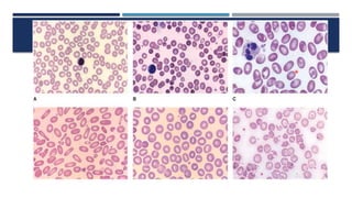 Comprehensive Overview of Congenital and Acquired Hemolytic Anemias | PPTX