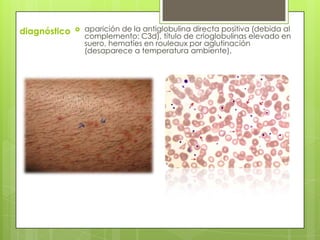 diagnóstico  aparición de la antiglobulina directa positiva (debida al
complemento: C3d), título de crioglobulinas elevado en
suero, hematíes en rouleaux por aglutinación
(desaparece a temperatura ambiente).
 