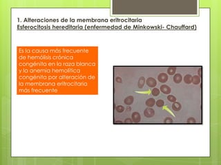 1. Alteraciones de la membrana eritrocitaria
Esferocitosis hereditaria (enfermedad de Minkowski- Chauffard)
Es la causa más frecuente
de hemólisis crónica
congénita en la raza blanca
y la anemia hemolítica
congénita por alteración de
la membrana eritrocitaria
más frecuente
 