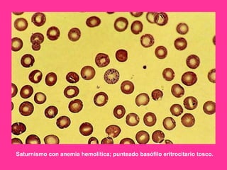 Saturnismo con anemia hemolítica; punteado basófilo eritrocitario tosco.

 