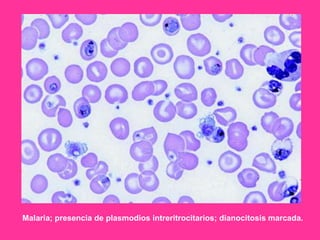 Malaria; presencia de plasmodios intreritrocitarios; dianocitosis marcada.

 