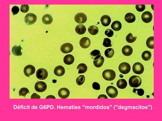 Déficit de G6PD. Hematíes "mordidos" ("degmacitos")

 