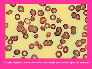 Cirrosis hepática. Anemia hemolítica de células en espuela ('spur cell anemia").

 