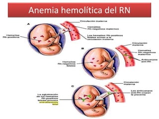 Anemia hemolítica del RN 
 