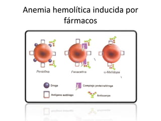 Anemia hemolítica inducida por 
fármacos 
