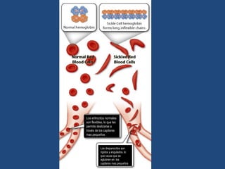 Los eritrocitos normales
son flexibles, lo que les
permite deslizarse a
través de los capilares
mas pequeños
Los drepanocitos son
rigidos y angulados, lo
que causa que se
aglutinen en los
capilares mas pequeños
 