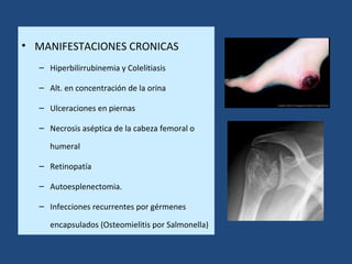 • MANIFESTACIONES CRONICAS
– Hiperbilirrubinemia y Colelitiasis
– Alt. en concentración de la orina
– Ulceraciones en piernas
– Necrosis aséptica de la cabeza femoral o
humeral
– Retinopatía
– Autoesplenectomia.
– Infecciones recurrentes por gérmenes
encapsulados (Osteomielitis por Salmonella)
 
