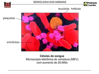 SEMIOLOGIA DAS ANEMIAS
Células do sangue
Microscopia eletrônica de varredura (MEV)
com aumento de 20.000x
plaquetas
eritrócitos
leucócito linfócito
 