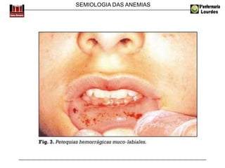 SEMIOLOGIA DAS ANEMIAS
 