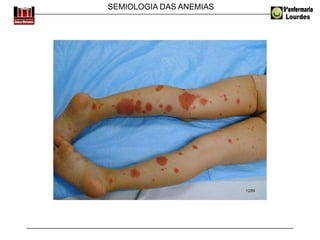 SEMIOLOGIA DAS ANEMIAS
 