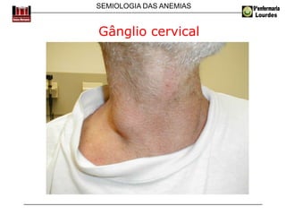 SEMIOLOGIA DAS ANEMIAS
Gânglio cervical
 