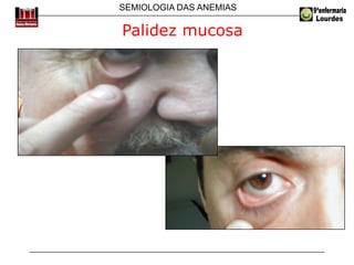 SEMIOLOGIA DAS ANEMIAS
Palidez mucosa
 