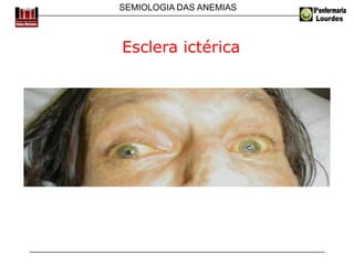 SEMIOLOGIA DAS ANEMIAS
Esclera ictérica
 