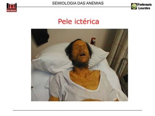 SEMIOLOGIA DAS ANEMIAS
Pele ictérica
 
