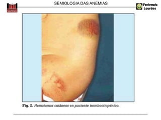 SEMIOLOGIA DAS ANEMIAS
 