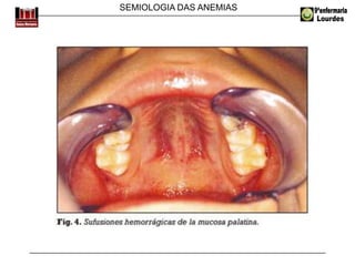 SEMIOLOGIA DAS ANEMIAS
 