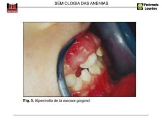 SEMIOLOGIA DAS ANEMIAS
 