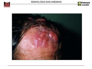 SEMIOLOGIA DAS ANEMIAS
 