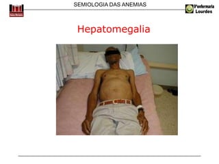 SEMIOLOGIA DAS ANEMIAS
Hepatomegalia
 