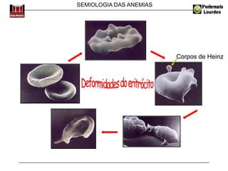 SEMIOLOGIA DAS ANEMIAS
Corpos de Heinz
 