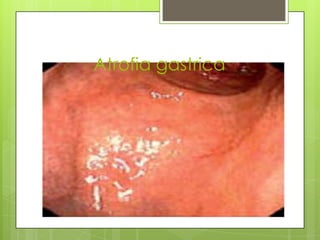 Atrofia gastrica

 