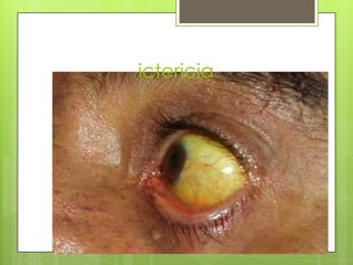 ictericia

 