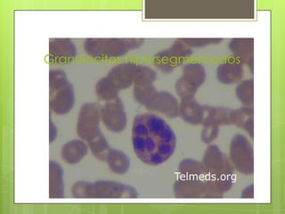 Granulocitos hipersegmentados

 