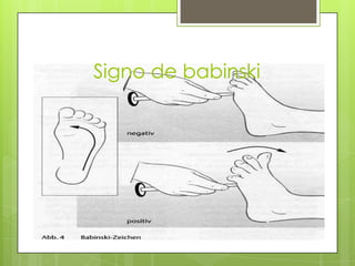 Signo de babinski

 
