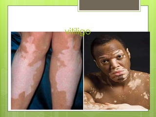 vitiligo

 