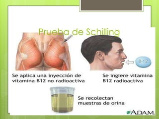 Prueba de Schilling

 