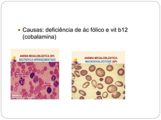  Causas: deficiência de ác fólico e vit b12
(cobalamina)
 