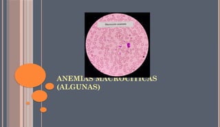 ANEMIAS MACROCÍTICAS
(ALGUNAS)
 
