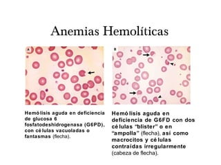 Anemias Hemolíticas
Hemó lisis aguda en deficiencia
de glucosa 6
fosfatodeshidrogenasa (G6PD),
con cé lulas vacuoladas o
fantasmas (flecha).
Hemó lisis aguda en
deficiencia de G6FD con dos
cé lulas “blister” o en
“ampolla” (flecha), así como
macrocitos y cé lulas
contraídas irregularmente
(cabeza de flecha).
 