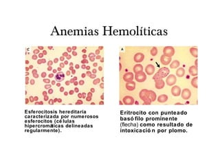 Anemias Hemolíticas
Esferocitosis hereditaria
caracterizada por numerosos
esferocitos (cé lulas
hipercromáticas delineadas
regularmente).
Eritrocito con punteado
basó filo prominente
(flecha) como resultado de
intoxicació n por plomo.
 
