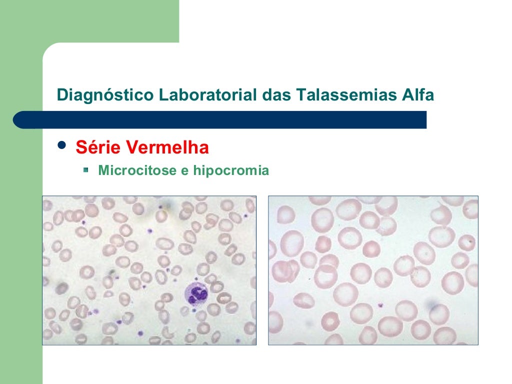 O Que Significa Normocitose E Normocromia No Exame De Sangue