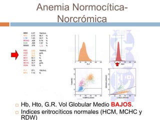Anemia Normocítica-
Norcrómica
 Hb, Hto, G.R. Vol Globular Medio BAJOS.
 Indices eritrocíticos normales (HCM, MCHC y
RDW)
 