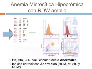 Anemia Microcítica Hipocrómica
con RDW amplio
 Hb, Hto, G.R. Vol Globular Medio Anormales.
 Indices eritrocíticos Anormales (HCM, MCHC y
RDW)
 