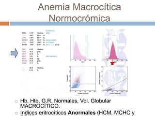 Anemia Macrocítica
Normocrómica
 Hb, Hto, G.R. Normales, Vol. Globular
MACROCÍTICO.
 Indices eritrocíticos Anormales (HCM, MCHC y
 