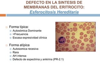  Forma típica:
 Autosómica Dominante
 >Frecuencia
 Escasa expresividad clínica
 Forma atípica
 Autosomica recesiva
 Rara
 AH intensa
 Defecto de espectrina y ankirina (PR-2.1)
DEFECTO EN LA SINTESIS DE
MEMBRANAS DEL ERITROCITO:
Esferocitosis Hereditaria
 