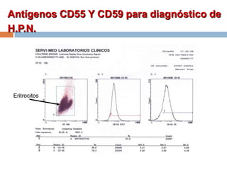 Antígenos CD55 Y CD59 para diagnóstico de
H.P.N.
Eritrocitos
 