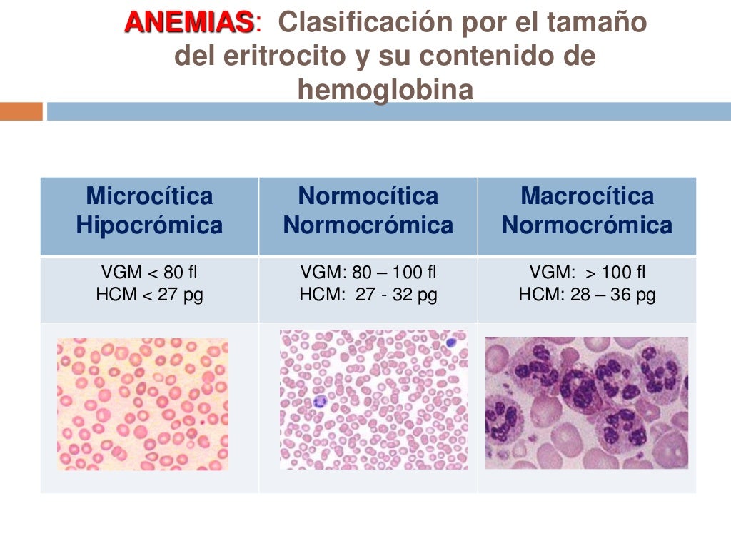 Anemias y laboratorio Anemias y laboratorio