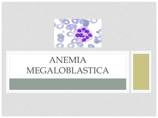 ANEMIA
MEGALOBLASTICA
 