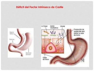 Déficit del Factor Intrínseco de Castle
 