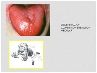 DEGENERACION
COMBINADA SUBAGUDA
MEDULAR
 