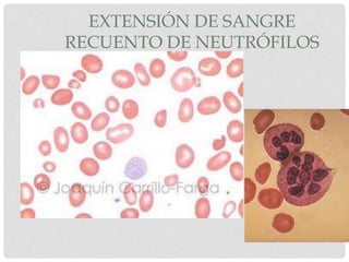 EXTENSIÓN DE SANGRE
RECUENTO DE NEUTRÓFILOS
 