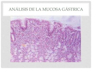 ANÁLISIS DE LA MUCOSA GÁSTRICA
 