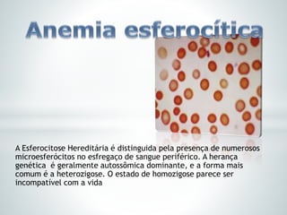 A Esferocitose Hereditária é distinguida pela presença de numerosos
microesferócitos no esfregaço de sangue periférico. A herança
genética é geralmente autossômica dominante, e a forma mais
comum é a heterozigose. O estado de homozigose parece ser
incompatível com a vida
 